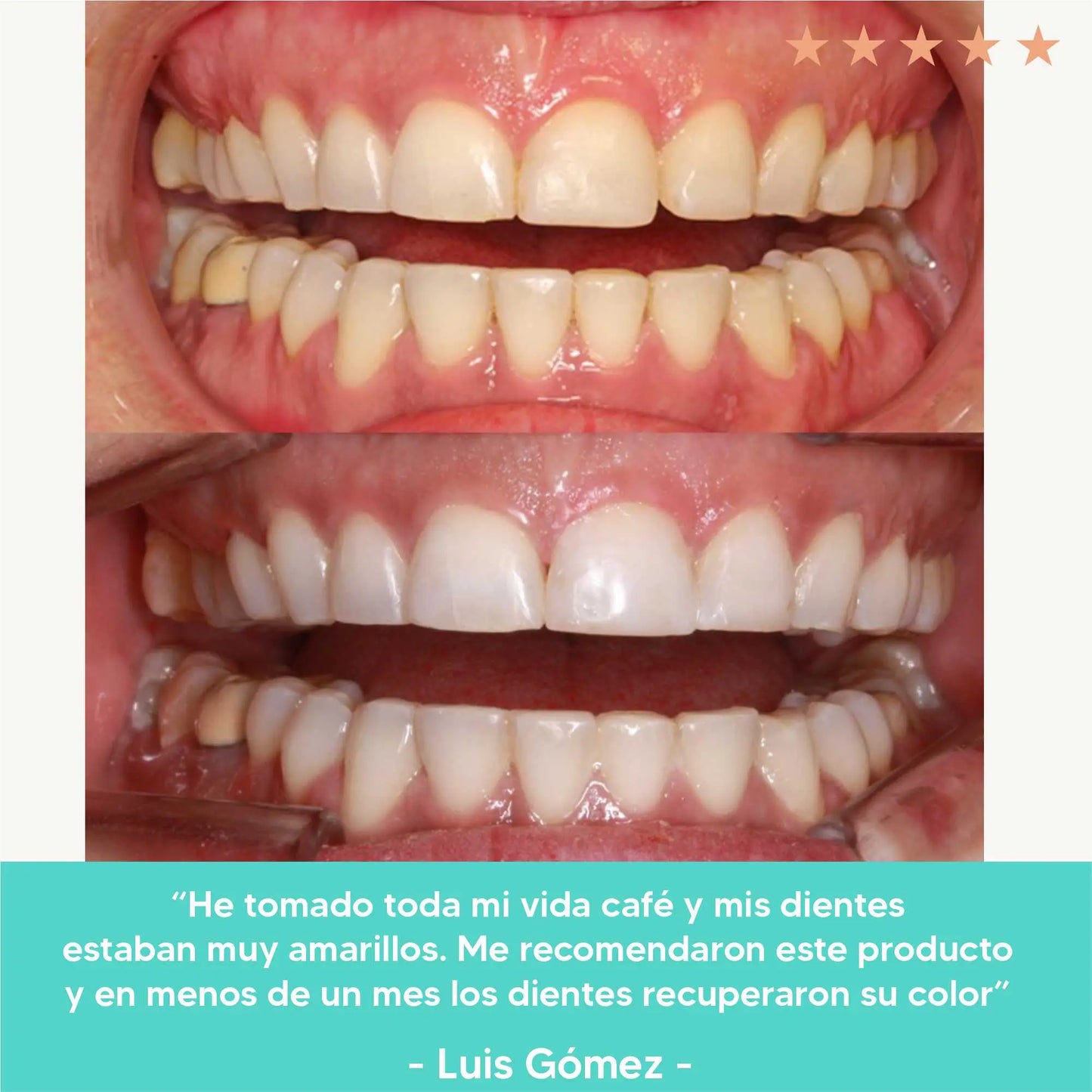 Elimina tus Manchas dentales y Mal aliento en 1 semana | Gratis Limpiador de lengua 🎁